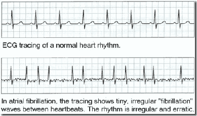FIBRILACE SÍNÍ - vznik mnohočetných okruhů funkčního reentry v myokardu síní EKG : vlny P nahrazeny fibrilačními vlnkami, nepravidelná srdeční akce - převod na komory zcela
