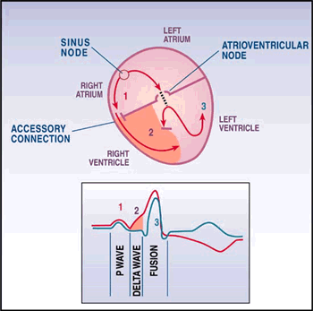 WOLFŮV-PARKINSONŮV-WHITEŮV SYNDROM = WPW EKG: při sinusovém rytmu obraz komorové preexcitace = delta vlna -zkrácený