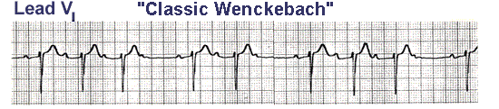 - I. typ = Wenckebachův typ EKG : postupné prodlužování intervalu PQ,