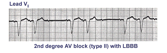 - II. typ = Mobitzův typ EKG : náhlý výpad komplexu QRS bez předchozích změn intervalu