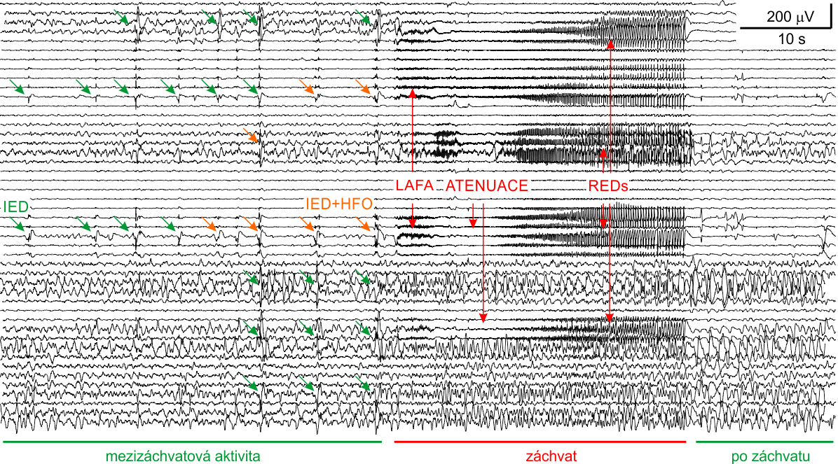 1 Úvod do problematiky Variabilita mezi pacienty, ale i jednotlivými záchvaty pacienta, zásadně komplikuje vytvoření automatických algoritmů pro identifikaci času začátku záchvatu a lokalizaci SOZ.
