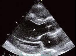 Echokardiografie potvrzení diagnózy srdečního selhání rychlé posouzení hemodynamiky kvantifikace systolické (diastolické) funkce LK zhodnocení funkce PK a
