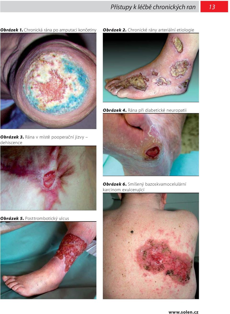 Chronické rány arteriální etiologie Obrázek 4.
