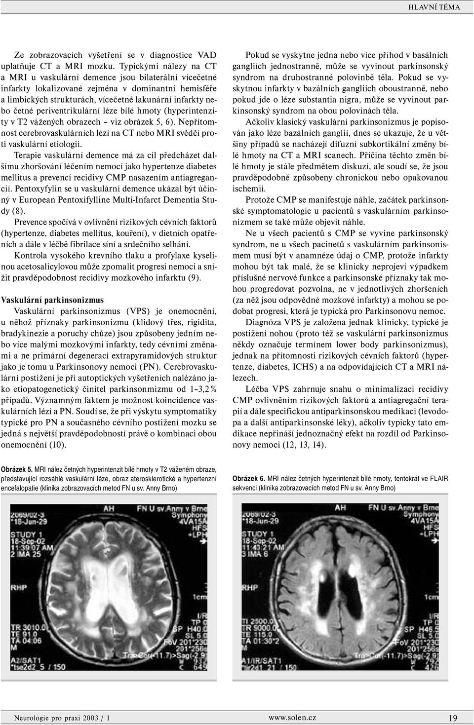 periventrikulární léze bílé hmoty (hyperintenzity v T2 vážených obrazech viz obrázek 5, 6). Nepřítomnost cerebrovaskulárních lézí na CT nebo MRI svědčí proti vaskulární etiologii.