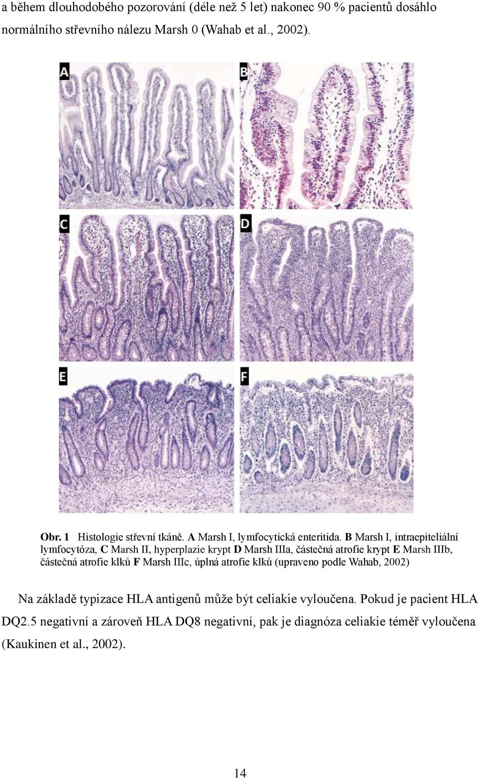 B Marsh I, intraepiteliální lymfocytóza, C Marsh II, hyperplazie krypt D Marsh IIIa, částečná atrofie krypt E Marsh IIIb, částečná atrofie klků F Marsh