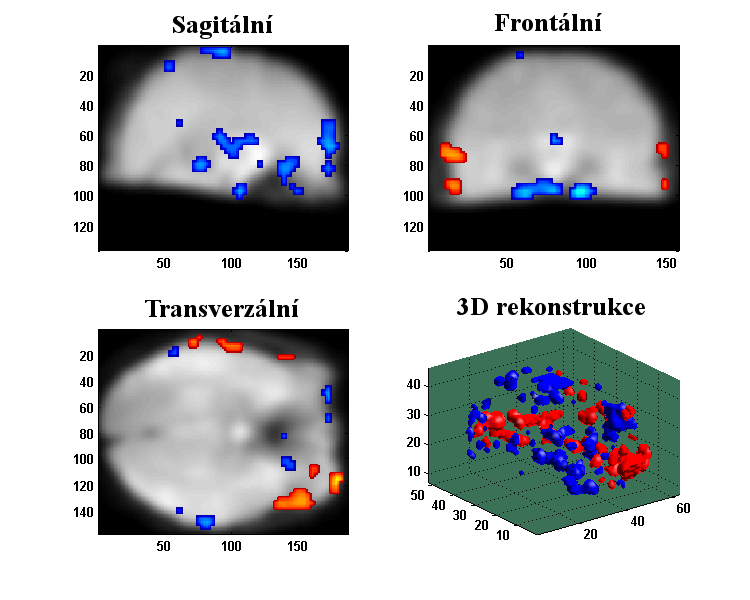 Obr. 6.4: První IC: Statistické vyhodnocení aktivace vstupního objemu fmri dat v jednotlivých rovinách a 3D rekonstrukce. Modrou barvou je znázorněna pozitivní aktivace, červenou potom negativní.