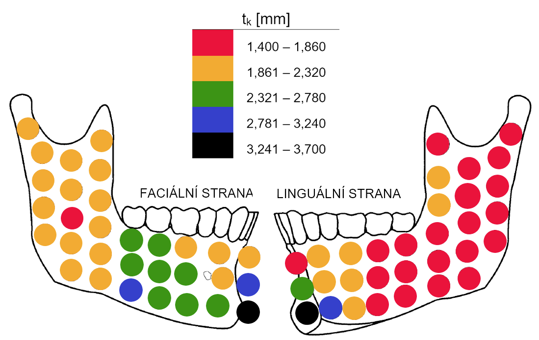 Tloušťka kortikální kosti Tloušťka kortikály t k dolní čelisti je z hlediska fixace totální endoprotézy velmi důležitá. Obvykle je její hodnota v rozmezí 1,4 1,7 mm (viz obr. 2.5).
