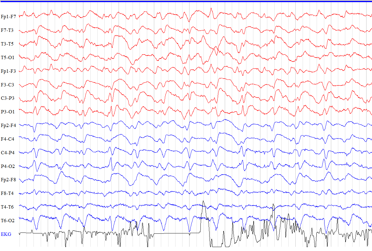 KAZUISTIKA 4 - EEG Fp1-F7 F7-T3 T3-T5 T5-O1 Fp1-F3 F3-C3 C3-P3 P3-O1 Fp2-F4 F4-C4 C4-P4 P4-O2 Fp2-F8 F8-T4 T4-T6 T6-O2 Fz-Avg Cz-Avg Pz-Avg EKG 600 µv/cm 15 Hz