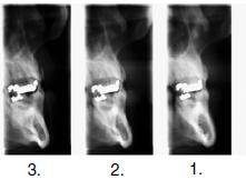 SNÍMKOVÁNÍ PŘÍČNÍCH REZŮ Automatická expozice V automatickém režimu budou na radiografu tři snímky. Požádejte pacienta, aby sevřel rty kolem nástavce pro zkus, polkl a zůstal pokud možno nehybný.