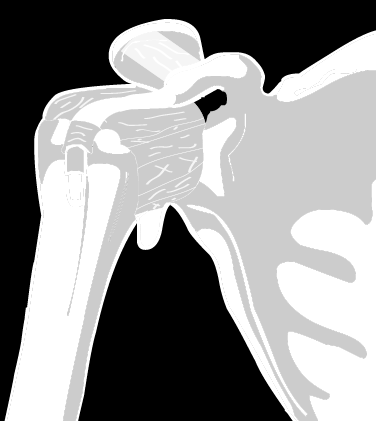 Articulatio humeri (glenohumeralis) 2 5 Kloubní pouzdro 5.1 Recessus axillaris 5.2 Vagina synovialis intertubercularis 6 Vazy: 6.1 Ligamentum coracohumerale 6.