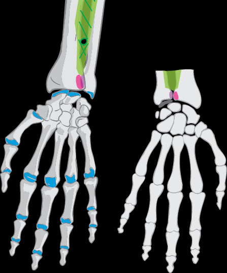 Articulatio radioulnaris distalis 1 Typ: jednoduchý 2 Tvar: kolový 3 Hlavice: circumferentia articularis capitis ulnae 4 Jamka: