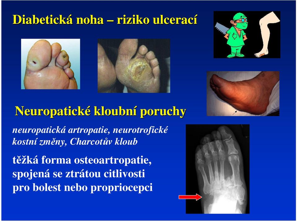 změy, Charcotův kloub těžká forma osteoartropatie,