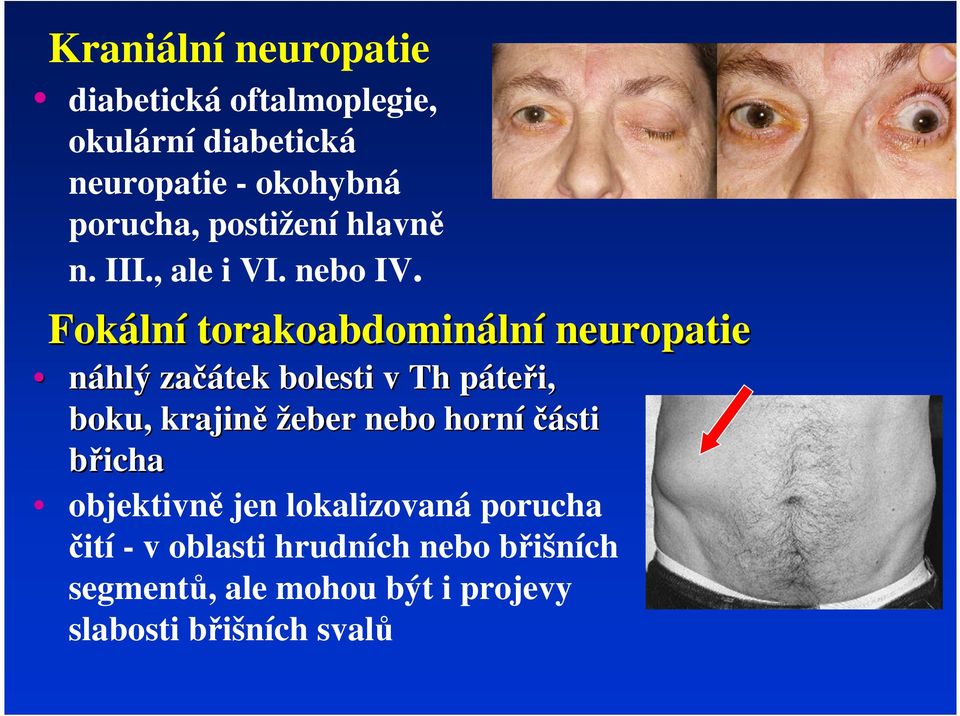 Fokálí torakoabdomiálí europatie áhlý začátek bolesti v Th páteři, boku, krajiě žeber ebo