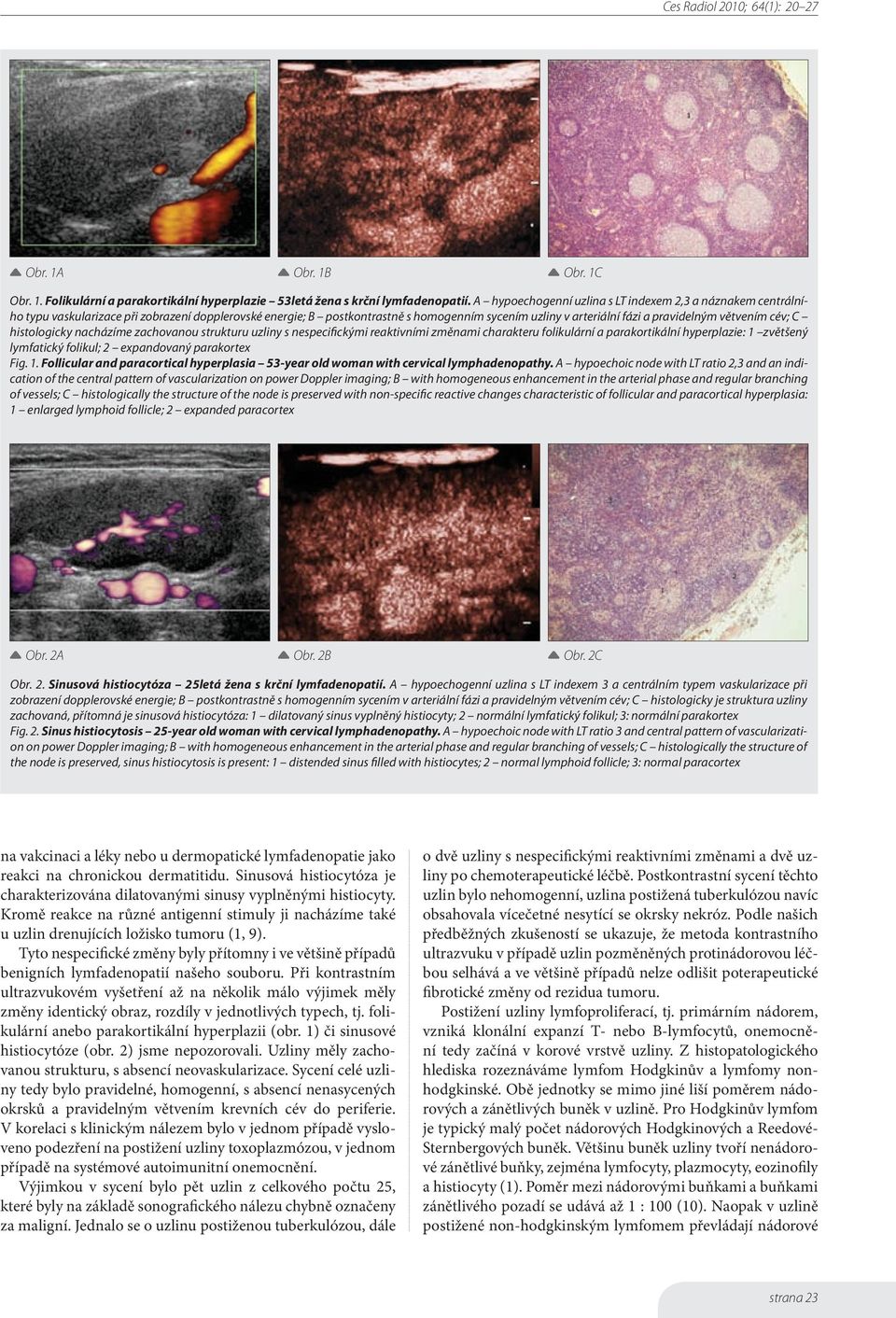 větvením cév; C histologicky nacházíme zachovanou strukturu uzliny s nespecifickými reaktivními změnami charakteru folikulární a parakortikální hyperplazie: 1 zvětšený lymfatický folikul; 2