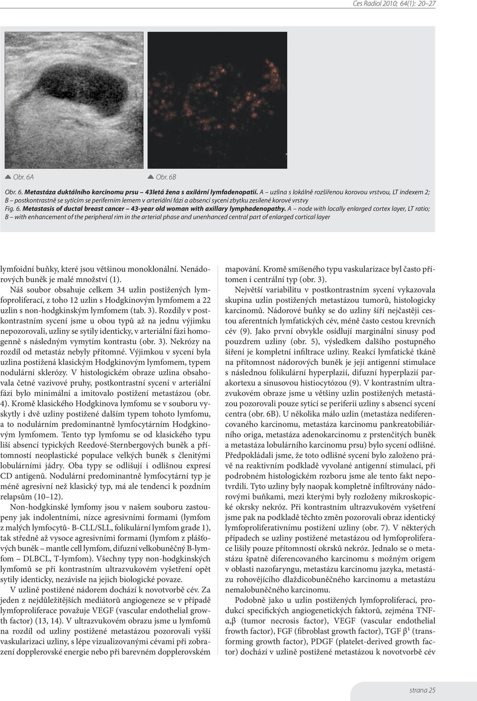 Metastasis of ductal breast cancer 43-year old woman with axillary lymphadenopathy.