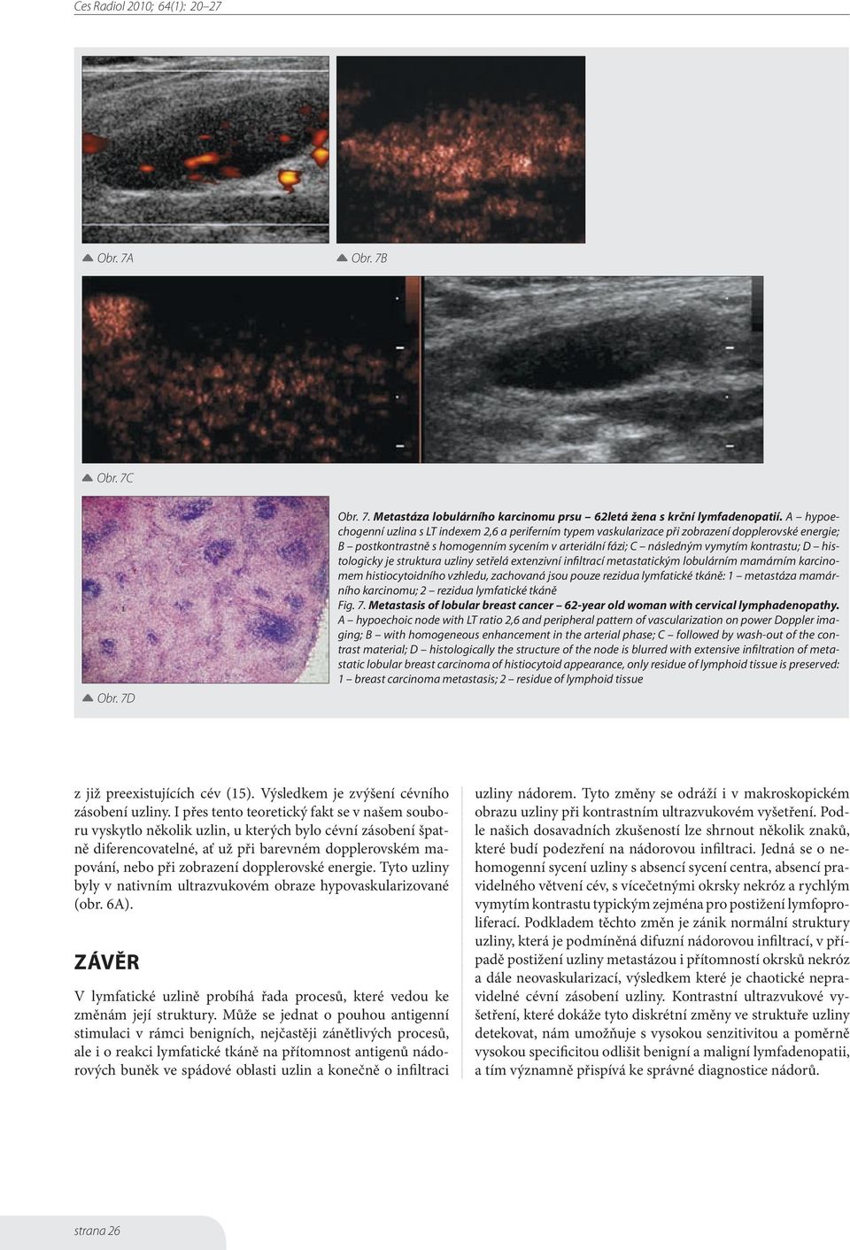 histologicky je struktura uzliny setřelá extenzivní infiltrací metastatickým lobulárním mamárním karcinomem histiocytoidního vzhledu, zachovaná jsou pouze rezidua lymfatické tkáně: 1 metastáza