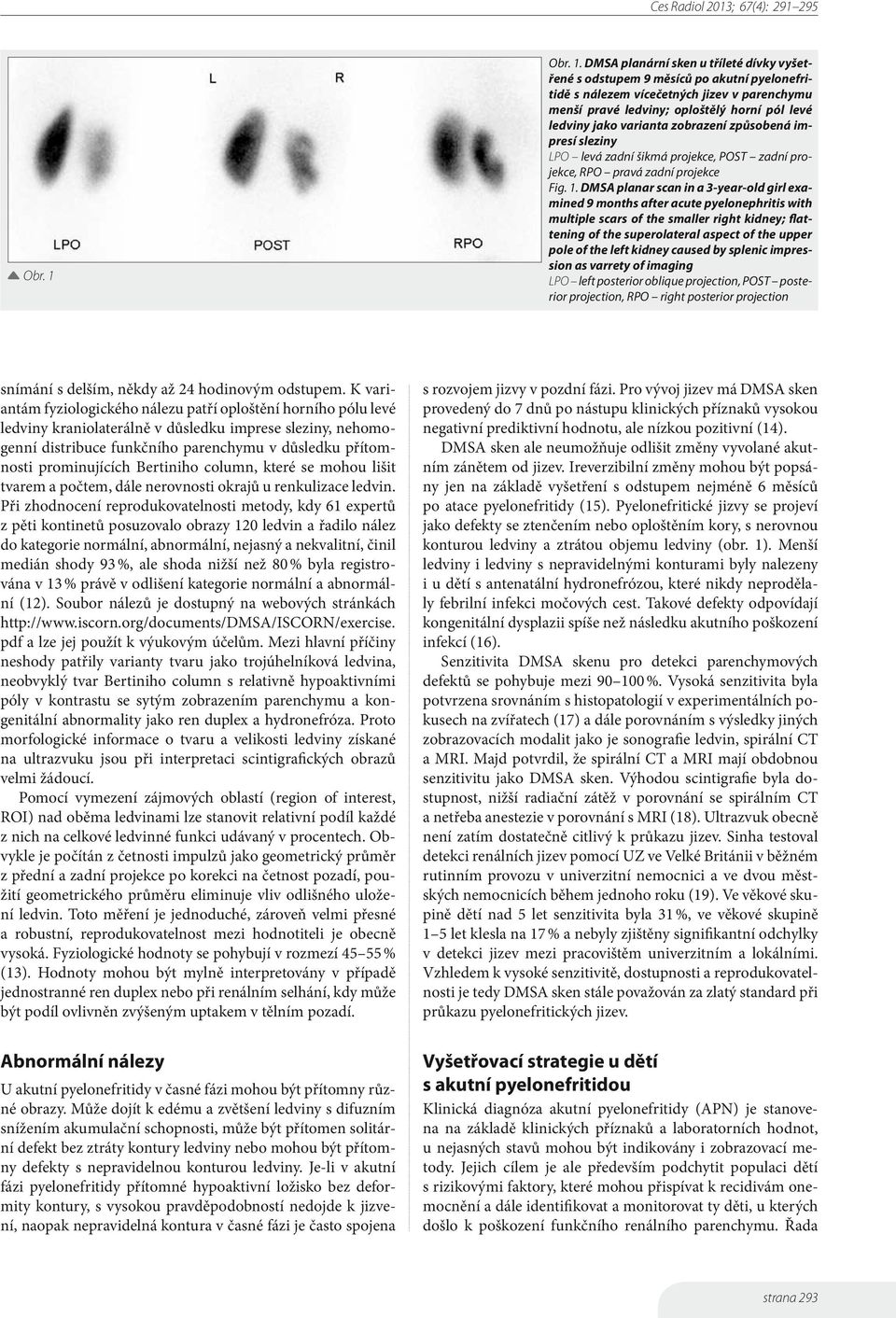 DMSA planární sken u tříleté dívky vyšetřené s odstupem 9 měsíců po akutní pyelonefritidě s nálezem vícečetných jizev v parenchymu menší pravé ledviny; oploštělý horní pól levé ledviny jako varianta