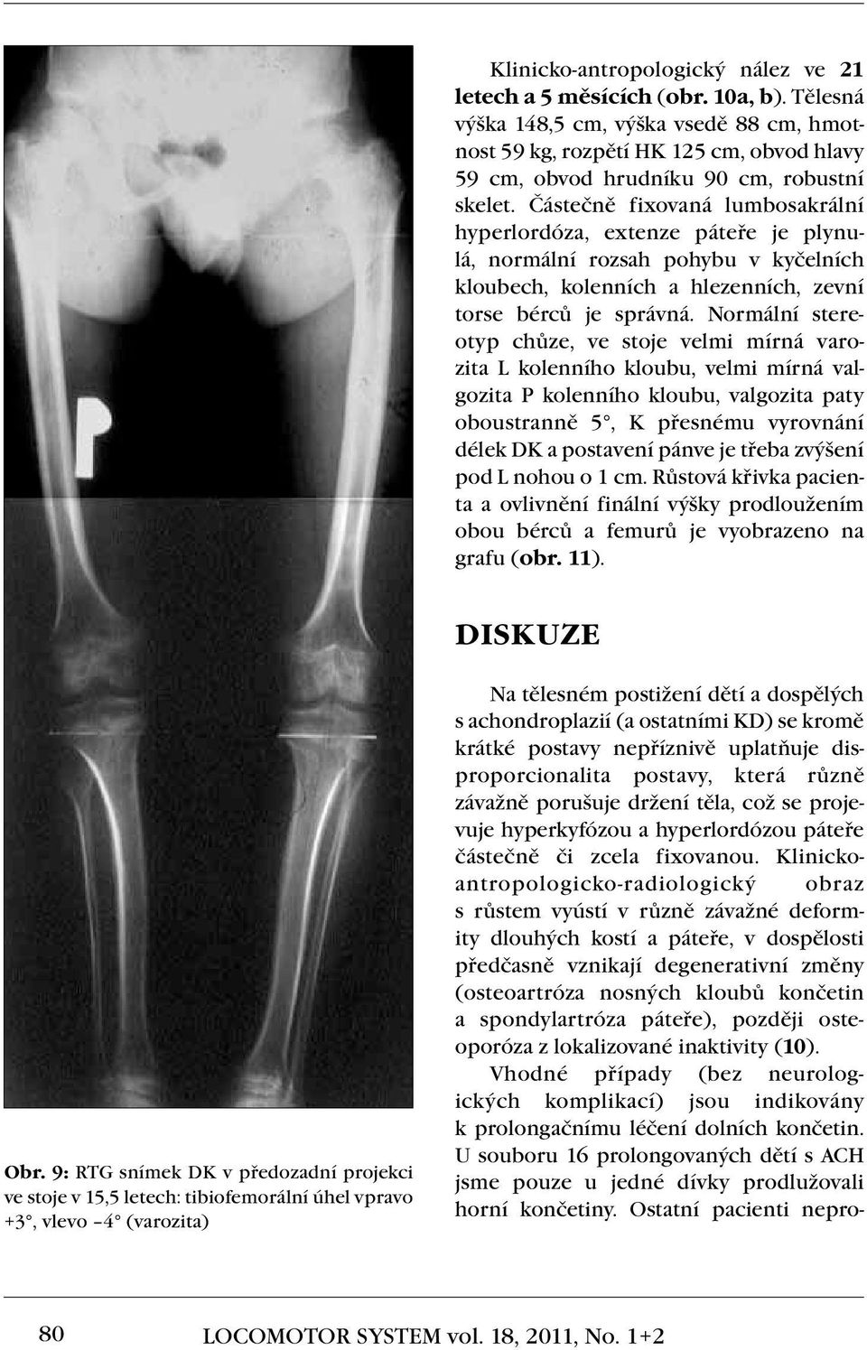 Částečně fixovaná lumbosakrální hyperlordóza, extenze páteře je plynulá, normální rozsah pohybu v kyčelních kloubech, kolenních a hlezenních, zevní torse bérců je správná.