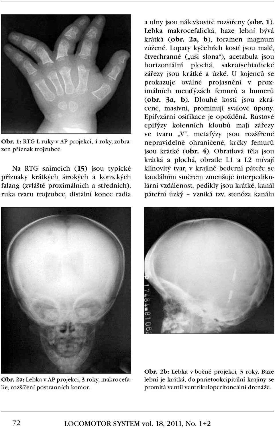 1). Lebka makrocefalická, baze lební bývá krátká (obr. 2a, b), foramen magnum zúžené.