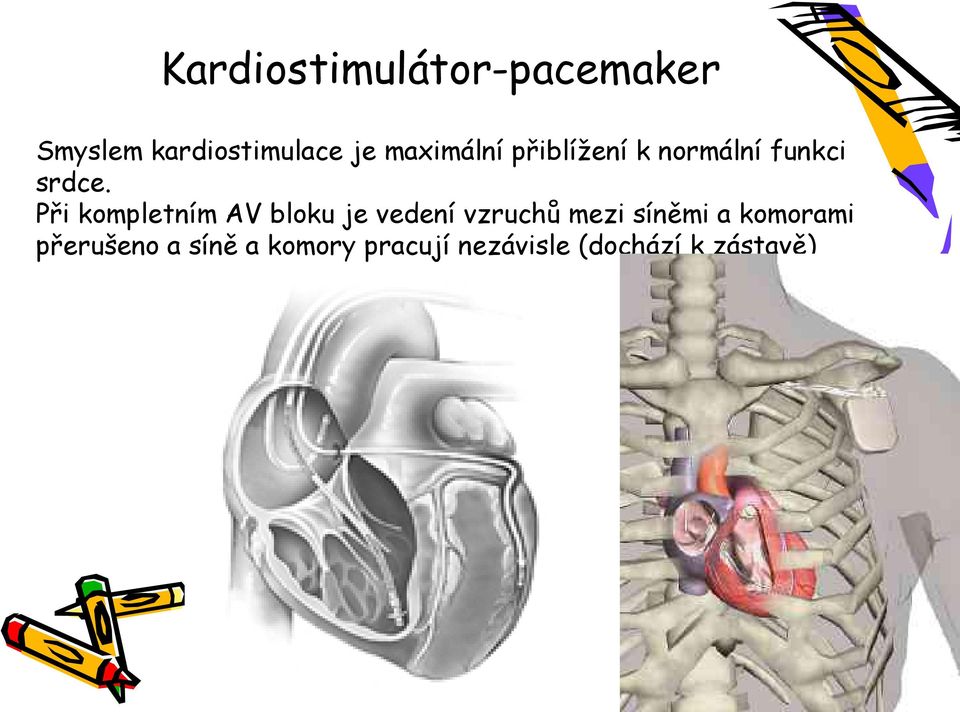 Při kompletním AV bloku je vedení vzruchů mezi síněmi a