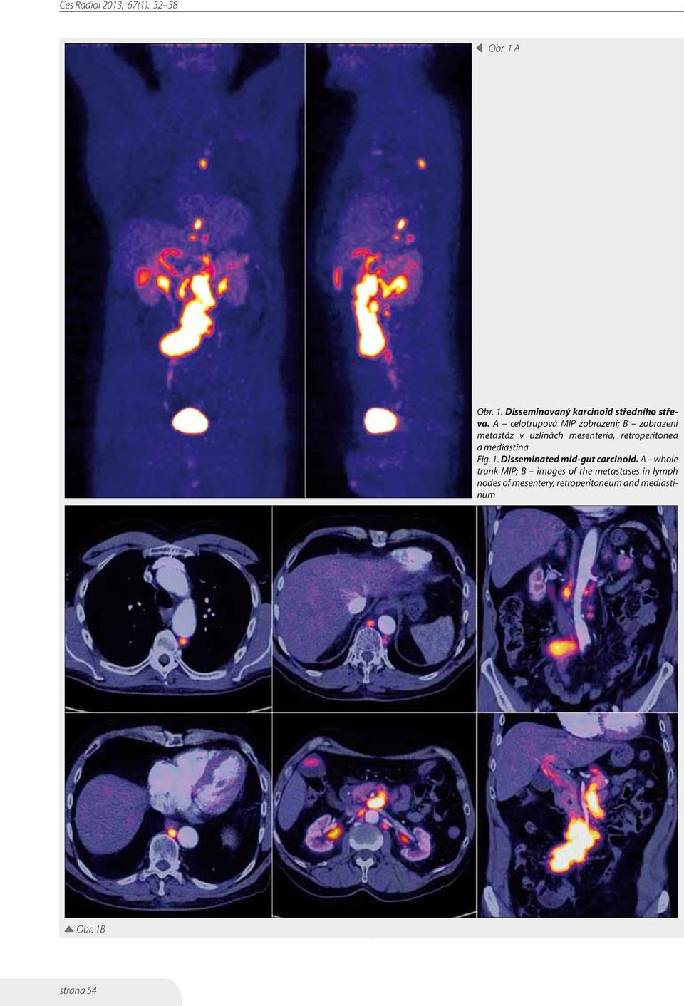 retroperitonea a mediastina Fig. 1. Disseminated mid-gut carcinoid.