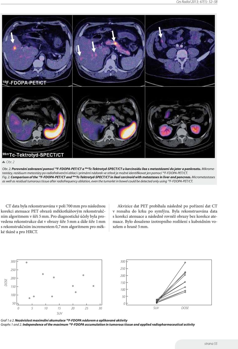 Comparison of the F-FDOPA-PET/CT and 99m Tc-Tektrotyd-SPECT/CT in ileal carcinoid with metastases in liver and pancreas.