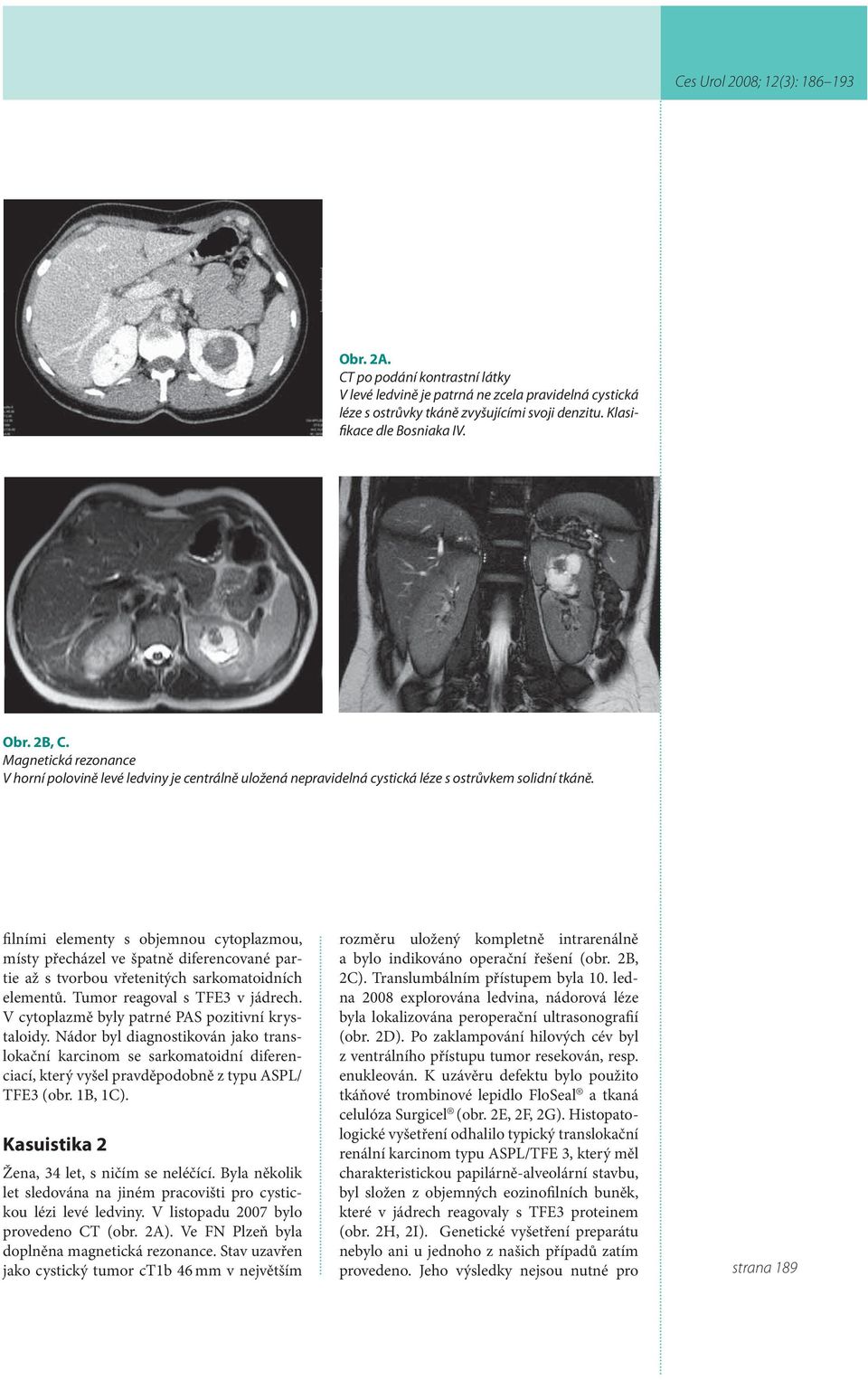 filními elementy s objemnou cytoplazmou, místy přecházel ve špatně diferencované partie až s tvorbou vřetenitých sarkomatoidních elementů. Tumor reagoval s TFE3 v jádrech.