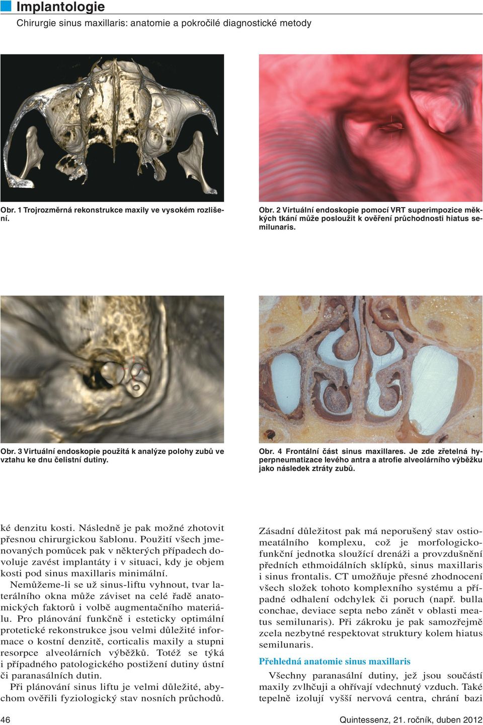 Je zde zřetelná hyperpneumatizace levého antra a atrofie alveolárního výběžku jako následek ztráty zubů. ké denzitu kosti. Následně je pak možné zhotovit přesnou chirurgickou šablonu.