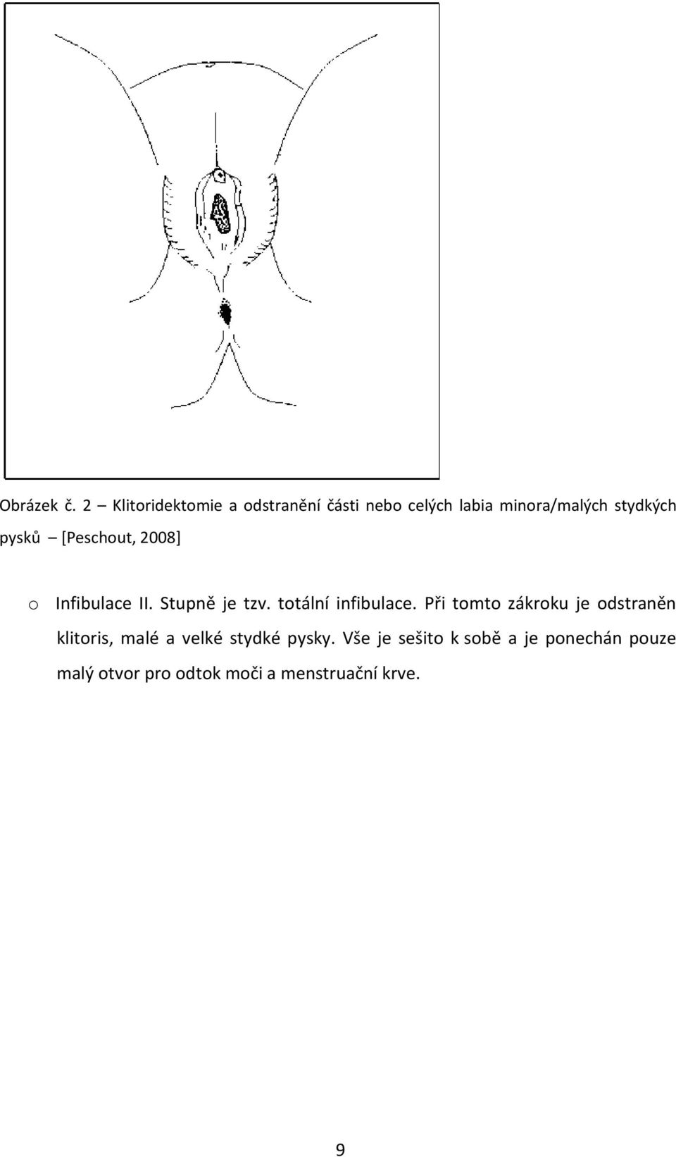 pysků [Peschout, 2008] o Infibulace II. Stupně je tzv. totální infibulace.