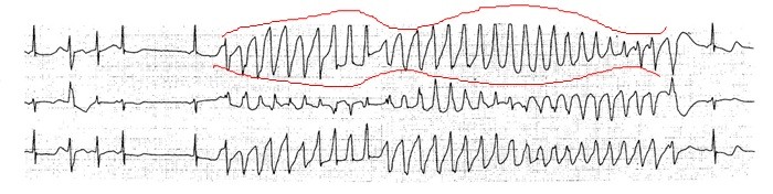 Obrázek č. 2 Flutter komor [http://vnl.xf.cz, 6] komorová tachykardie Komorová tachykardie je zrychlená srdeční činnost s frekvencí nad 100/ minutu. Obvykle je frekvence 150 200/ minutu.