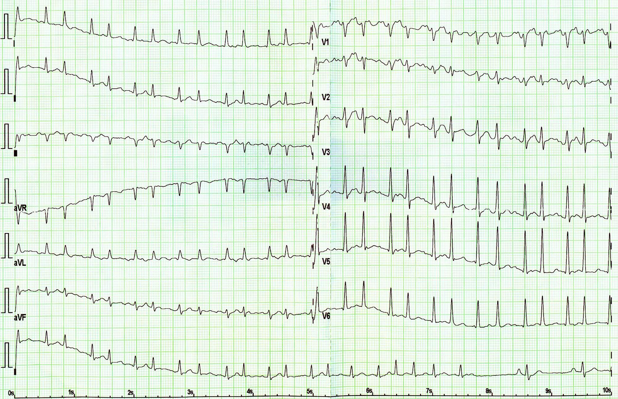 FS - EKG