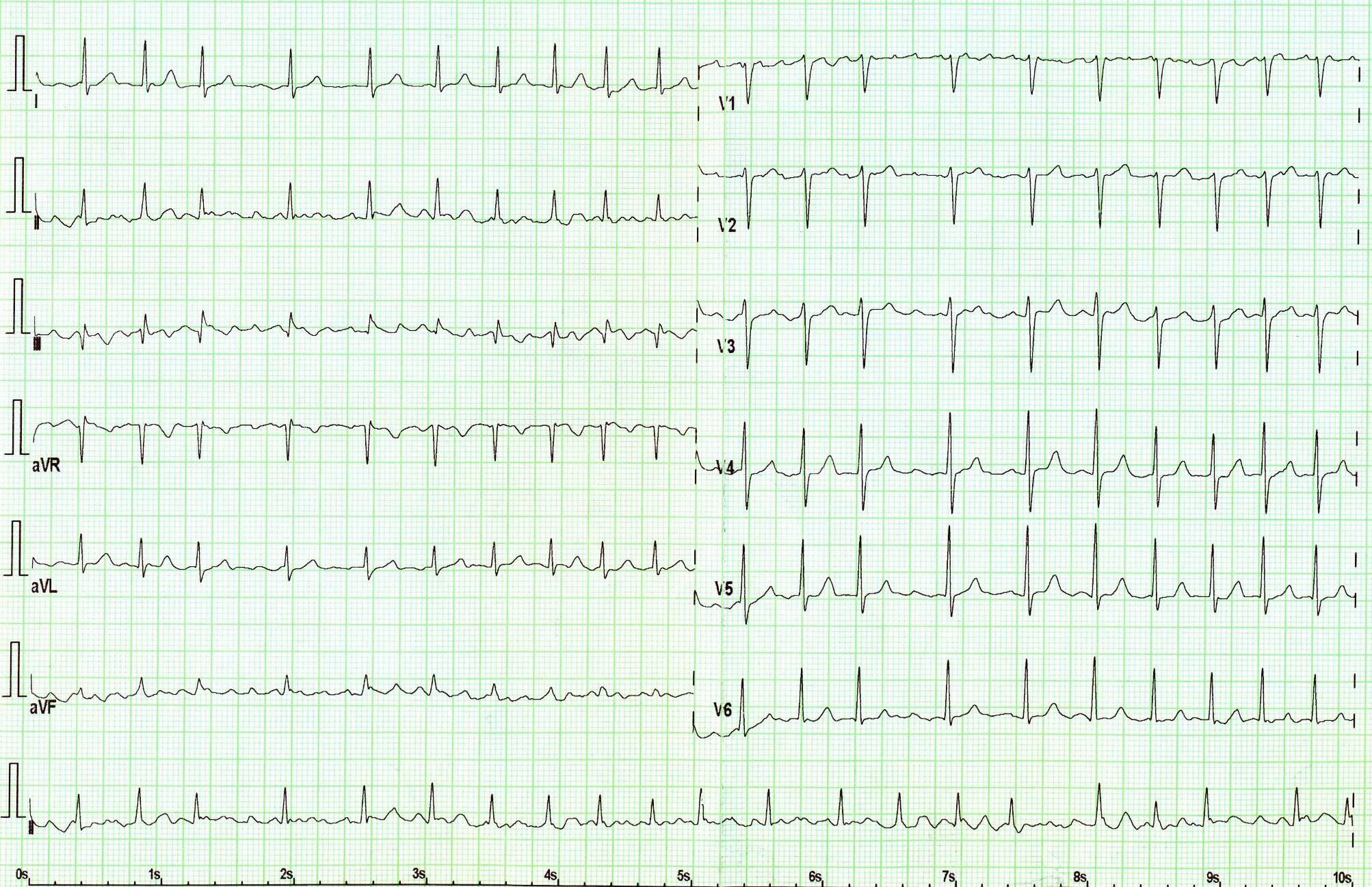 DG - ECG