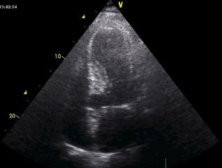 subaortálně >15 mm s normální midseptální tloušťkou - ESLV axis úhel k LVOT > 60