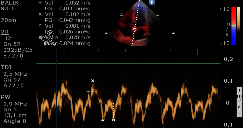 Echo parametry diastolické funkce: TDI (TVI) - Low