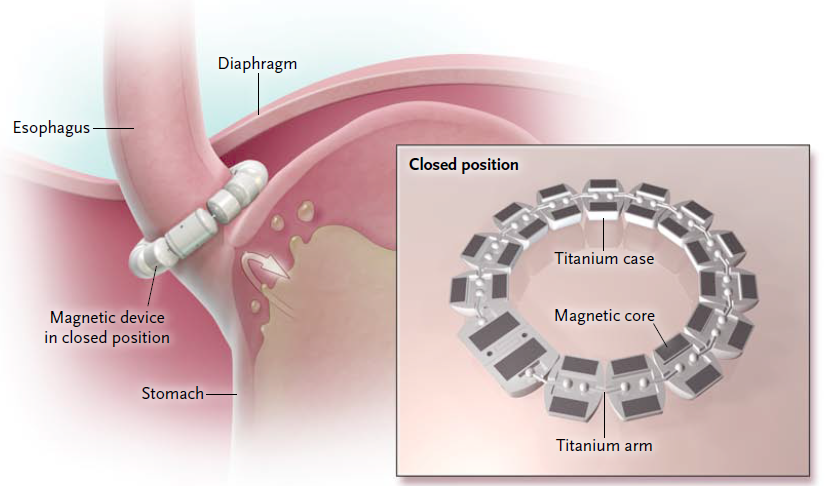 Magnetický svěrač jícnu v léčbě GERD V uzavřené pozici