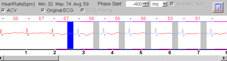 ECG triggering spouštění expozice v nastavené fázi rytmu zde telediastolická fáze Stanoven pevně počáteční bod zapnutí expozice 400 ms před kmitem R EKG Mimo zvolený segment retgenka nezáří