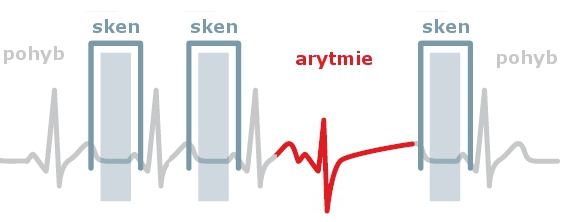 7.4 Spouštěný scan EKG S příchodem moderních multislice výpočetních tomografů s velkou rotační rychlostí gantry bylo umožněno zobrazení srdečního svalu i jeho cévního zásobení.