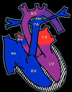 Postnatální změny cirkulace Tok z pravé komory do ascendentní aorty cestou ductus arteriosus Ductus arteriosus se začíná