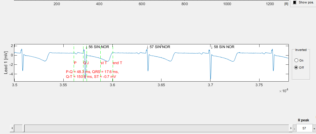 Obr. 21 Zobrazení 2 svodů EKG, na ose x jsou