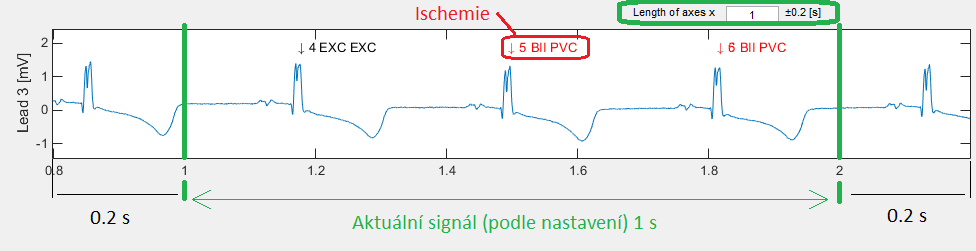 těchto údajů se vykreslí jednotlivé grafy. Vykreslení jednotlivých grafů EKG se od sebe téměř neliší. Nejdříve se zjistí, který signál se má v daném okně vykreslit.