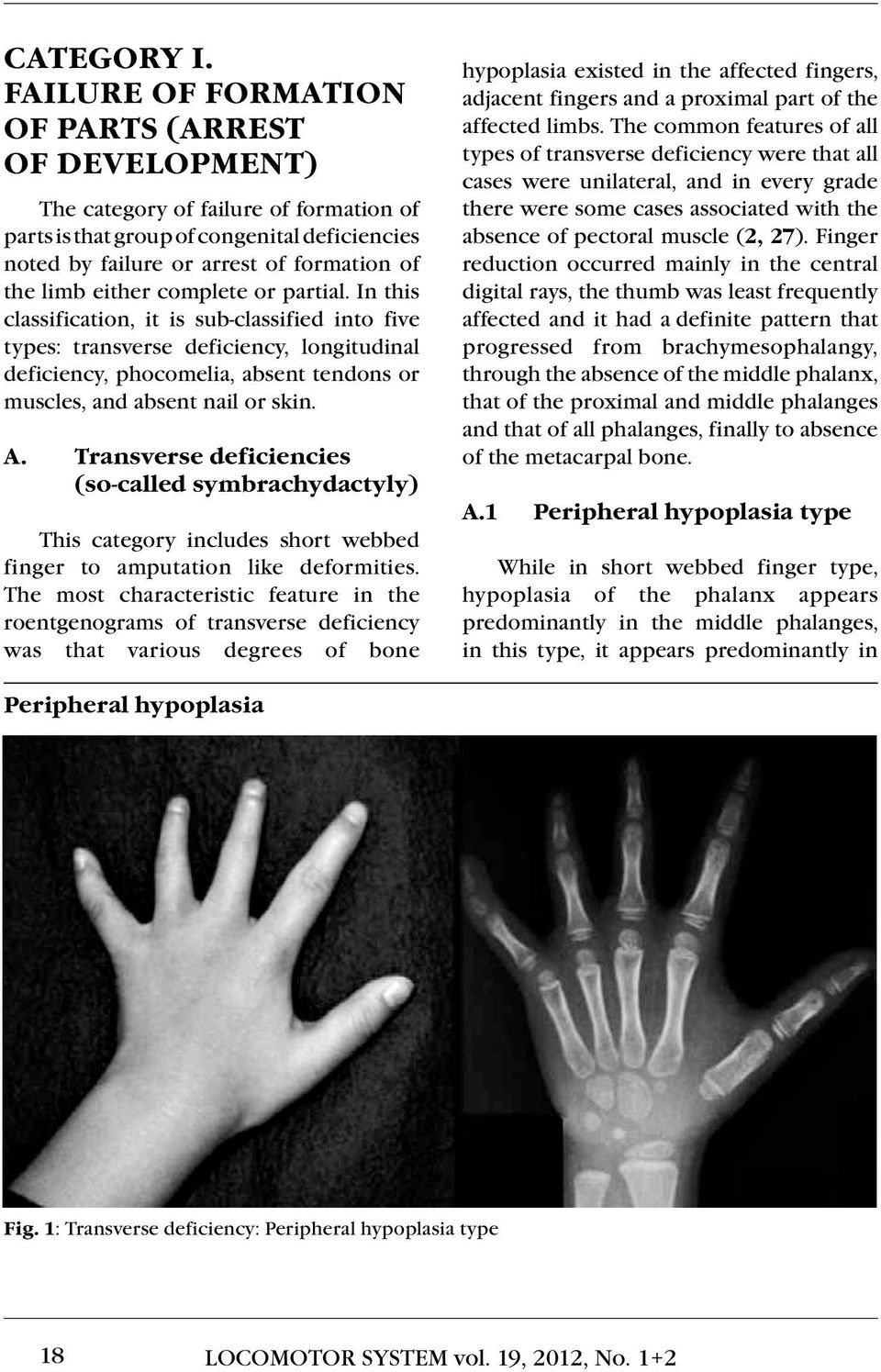 complete or partial. In this classification, it is sub-classified into five types: transverse deficiency, longitudinal deficiency, phocomelia, absent tendons or muscles, and absent nail or skin. A.