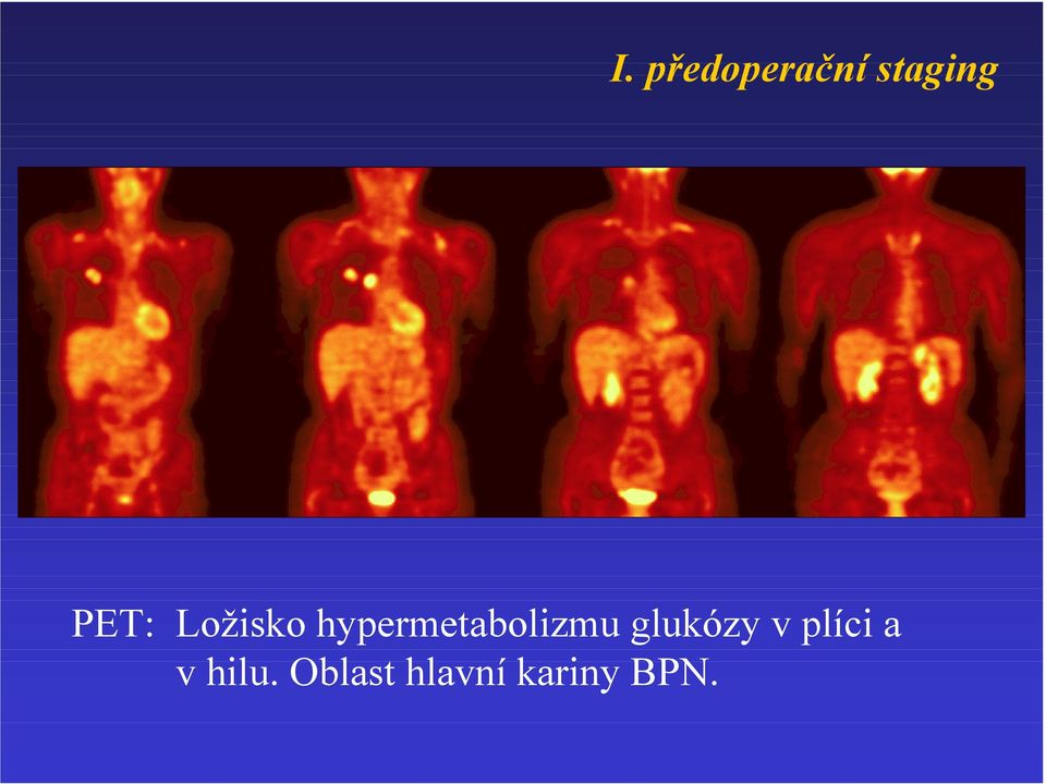 hypermetabolizmu glukózy v