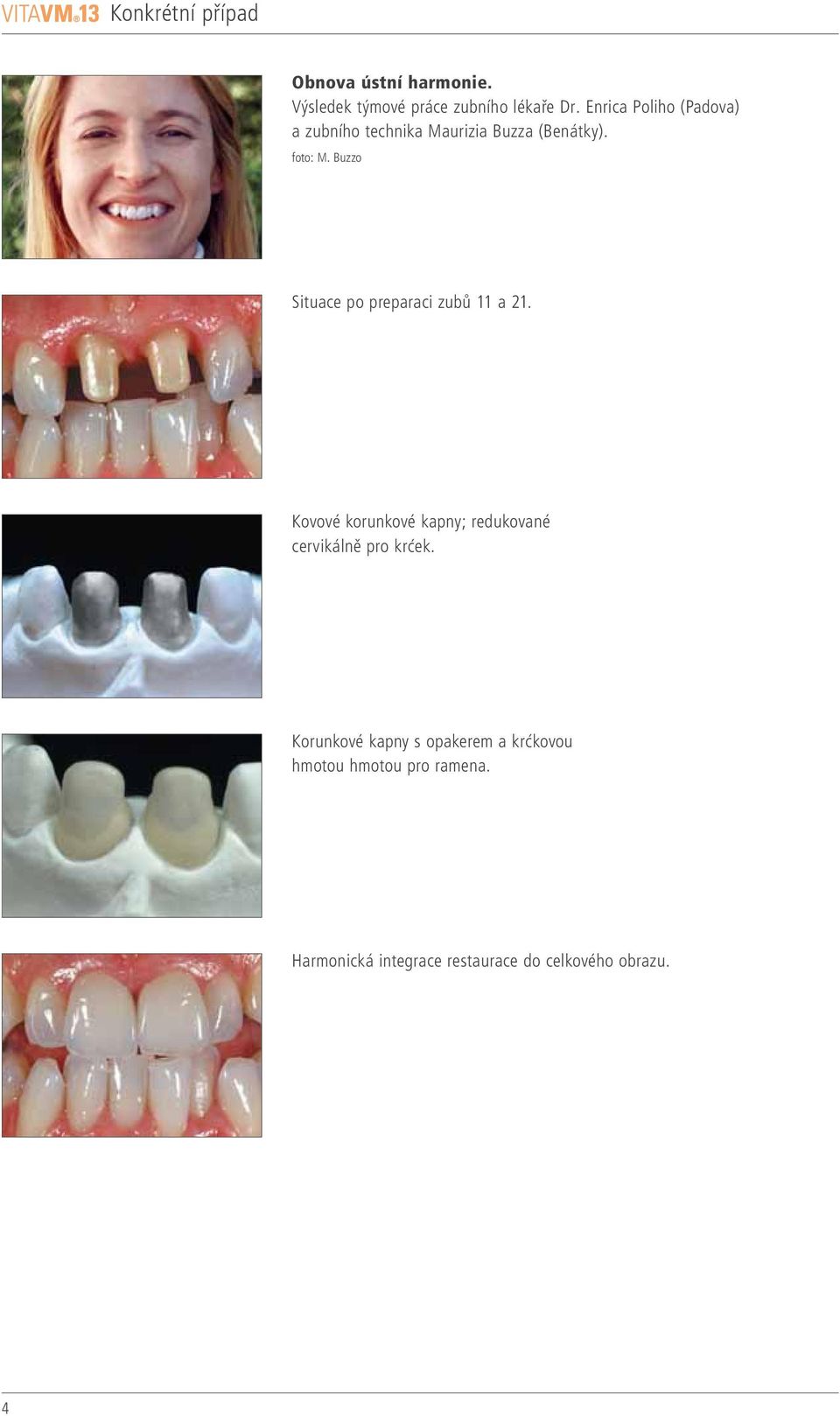Buzzo Situace po preparaci zubů a 2. Kovové korunkové kapny; redukované cervikálně pro krćek.