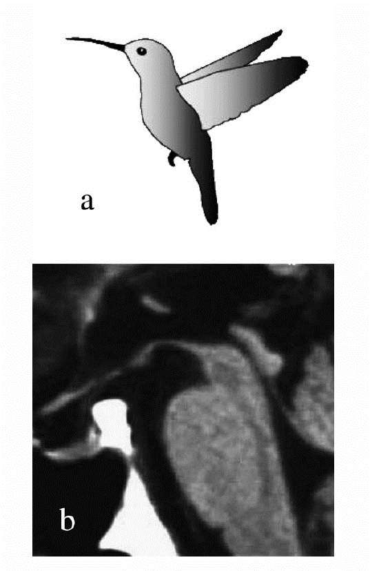 MRI