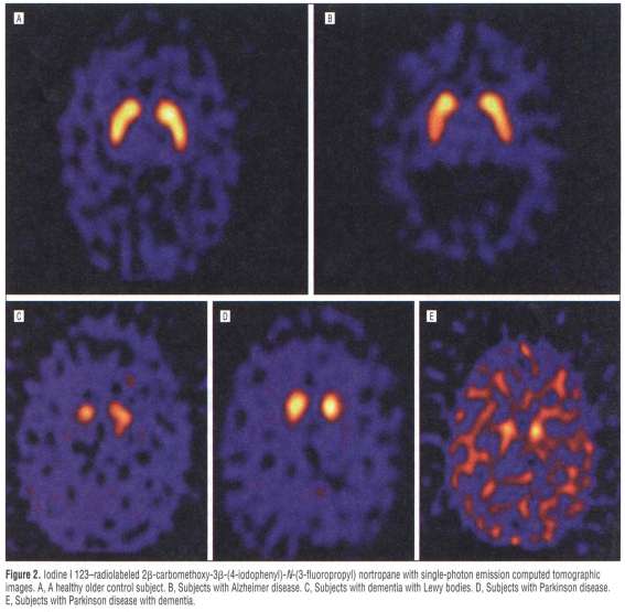 FP-CIT SPECT: DLB