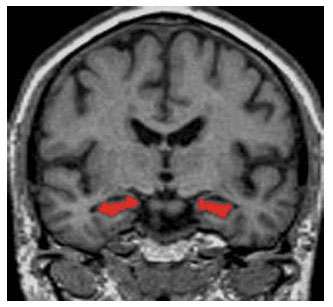 Default mode síť u AD Snížení klidové aktivity v PCC, precuneu a hippocampu u pacientů s AN (Greicius, 2004)