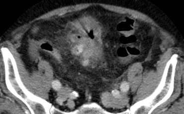 Klasifikace Hinchey Ib Peri/mesokolicky absces < 5