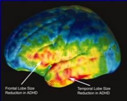 NEUROANATOMIE 1/2 o porucha prefrontálně-striato-thalamického kortikálního okruhu o