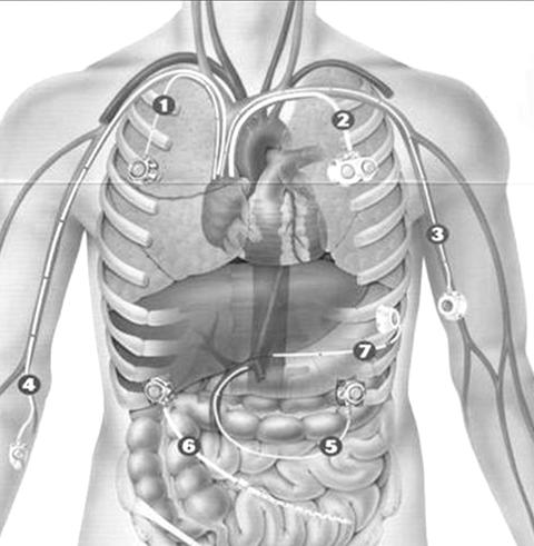 Obrázek 7 Peritoneální port: Celsite Peritoneal. 2016. In: B. Braun Melsungen AG [online]. [cit. 2016-03-21]. Dostupné z: http://www.bbraun.com/cps/rde/xchg/bbraun-com/hs.xsl/products.html?