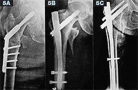 Příloha 3: Příklady osteosyntézy trochanterických zlomenin.